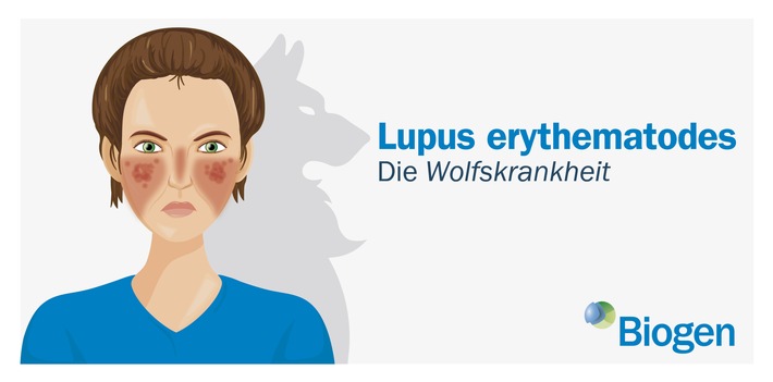 Biogen Aktuell: Lupus erythematodes: Wie sich Biotechunternehmen dem "roten Wolf" stellen