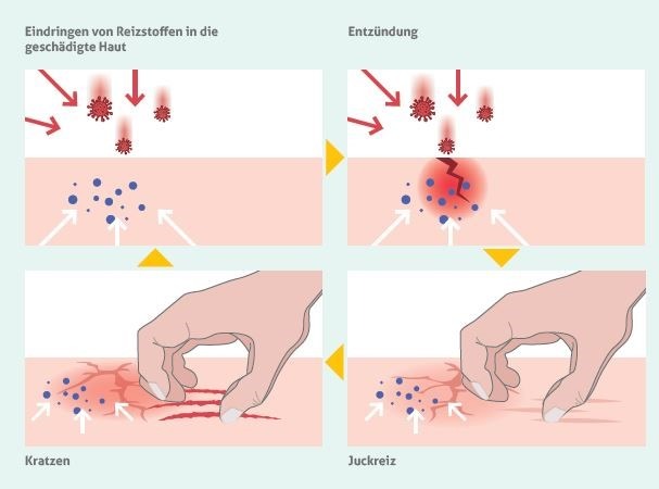 Neurodermitis-Schübe im Frühling: Auch die Haut kann während der Pollensaison leiden